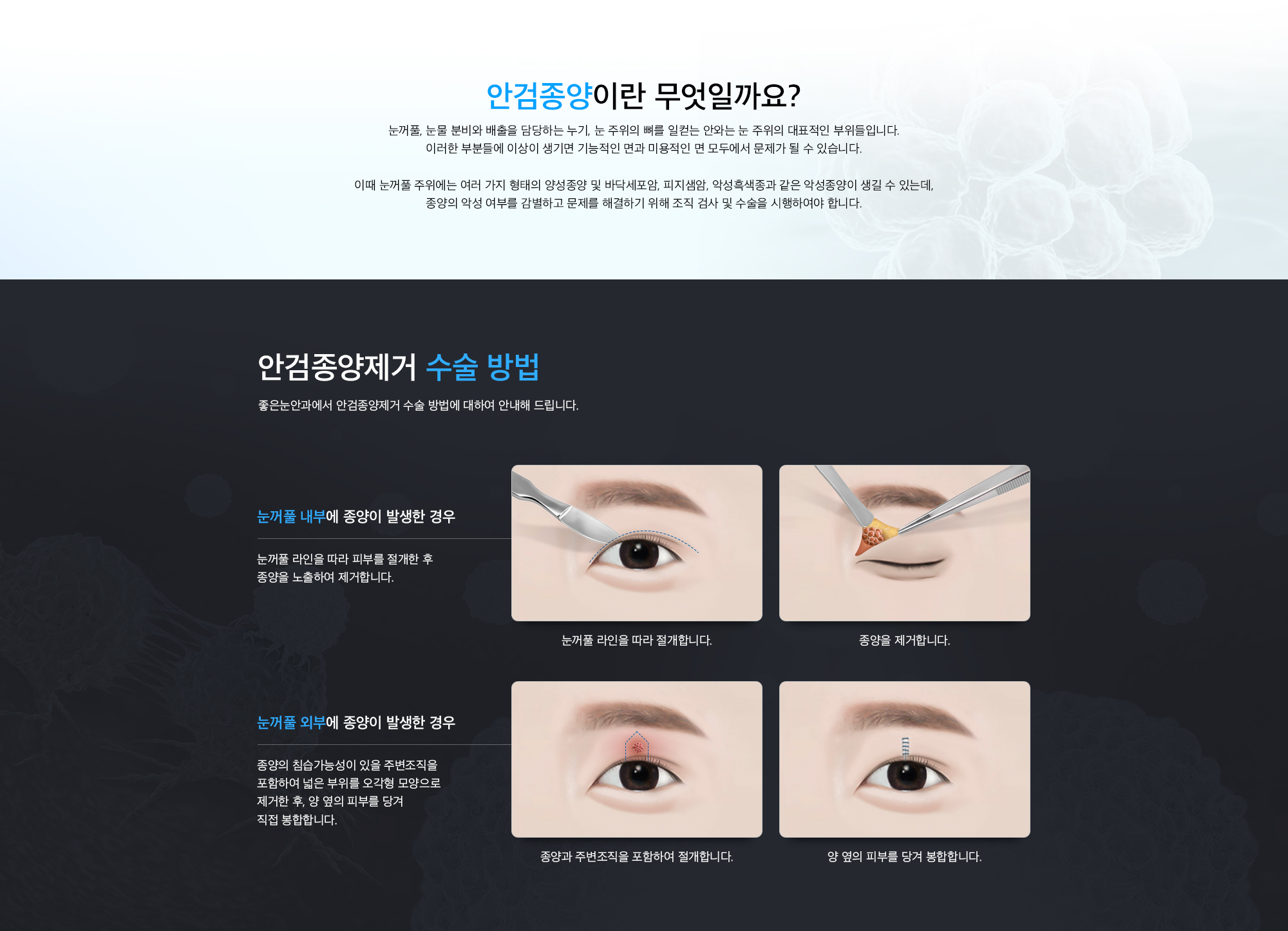 안검종양제거